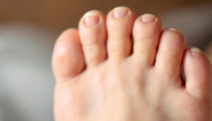 A photograph of a close-up of a person's foot with a focus on an ingrown toenail